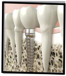 Dental Implants Periodontist Auburn Wa
