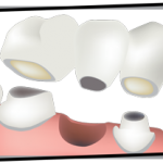 Dental Bridge