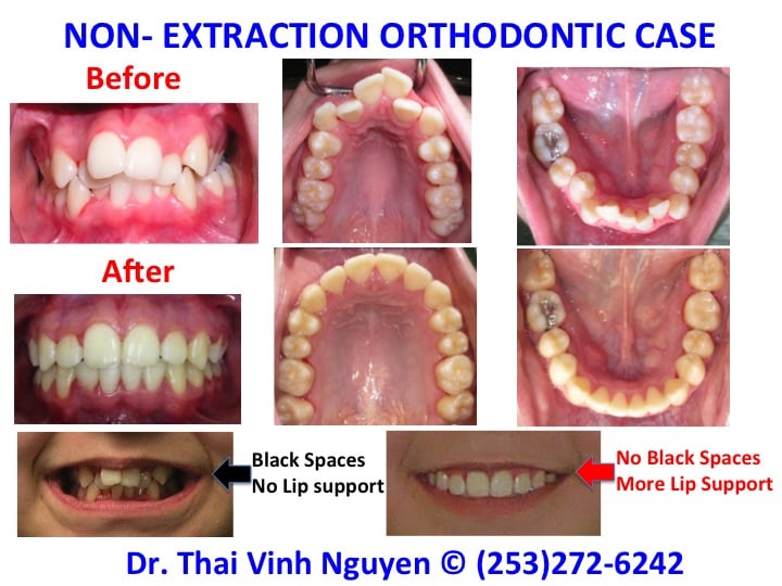 NonExtraction Orthodontics Treatment Excellent Dental Care Center